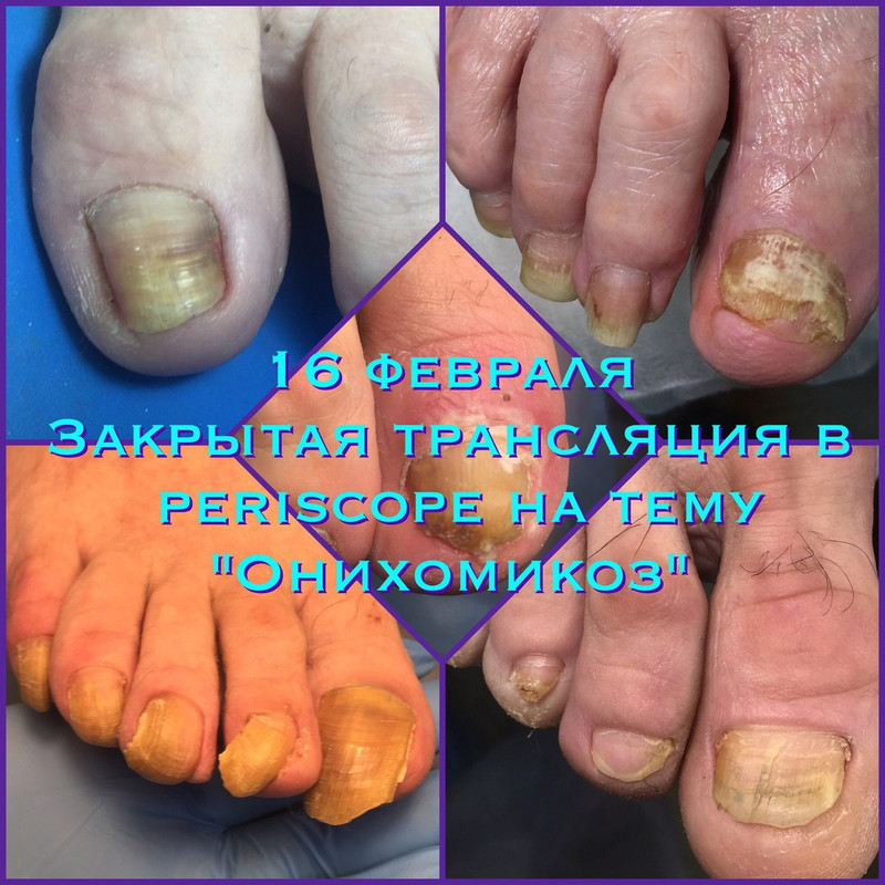 Онихомикоз, 2017 (Агата Черная)
